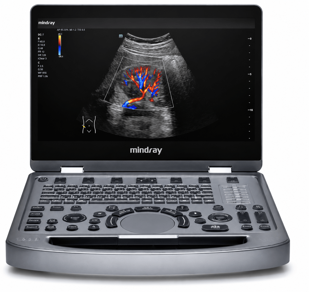 bitrix_img_1782778980_591 Ultrasonido Mindray MX6 Transductor: Convexo y Lineal